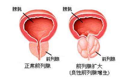 什么是前列腺增生